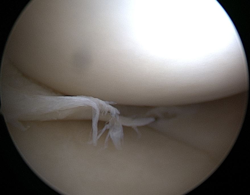 Arthroskopie des Kniegelenk Meniskusriß